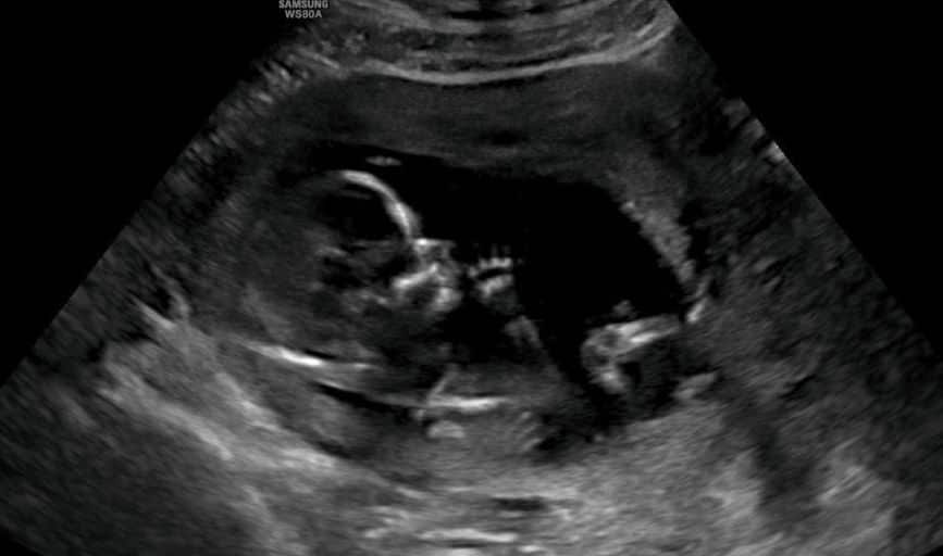 Prenatal Ultrasound